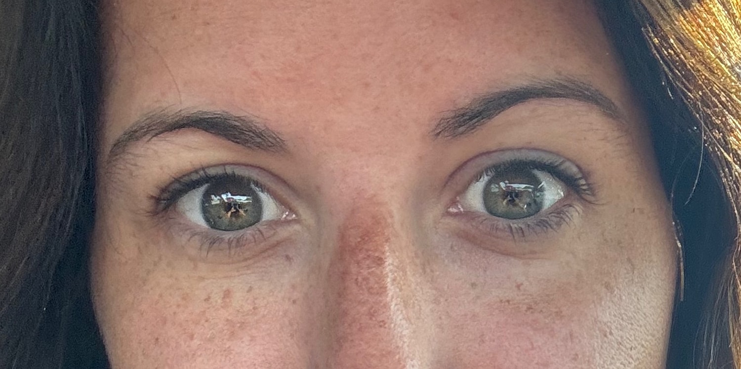 Under Eye Treatment Gallery Before & After