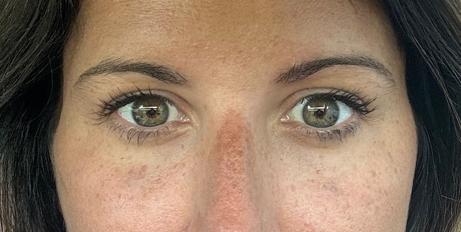 Under Eye Treatment Gallery Before & After