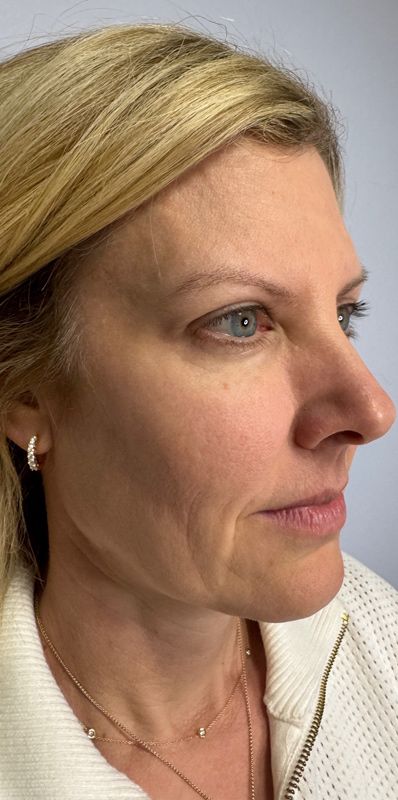 Biostimulators Gallery Before & After