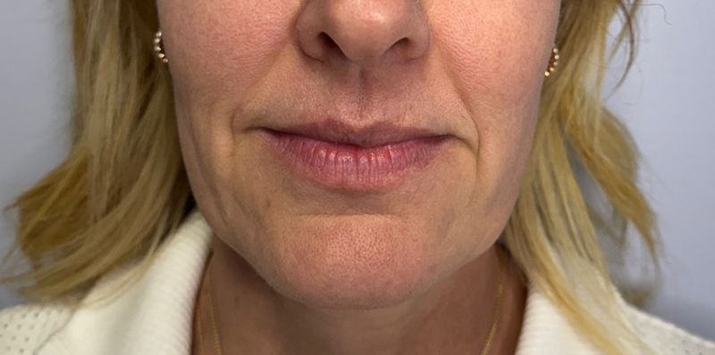 Biostimulators Gallery Before & After