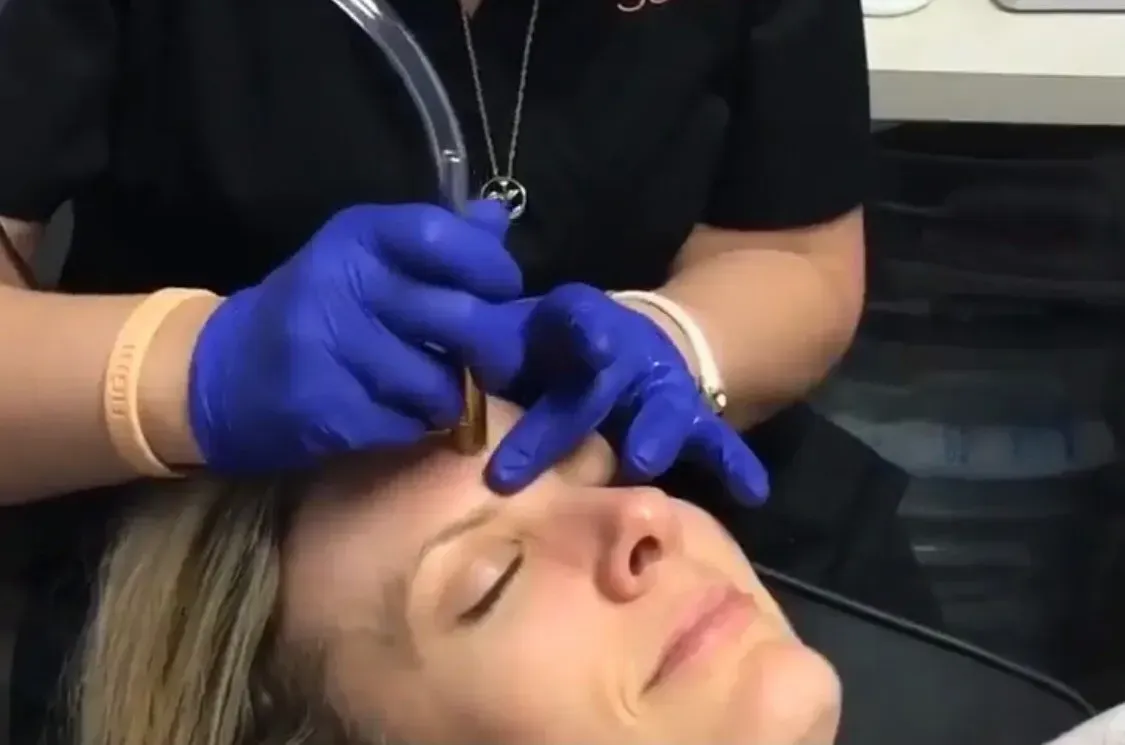 west columbia dermaplaning patient receiving treatment